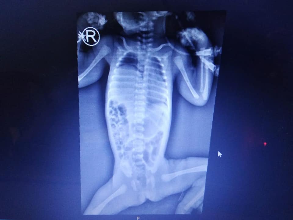 Eventration of diaphragm